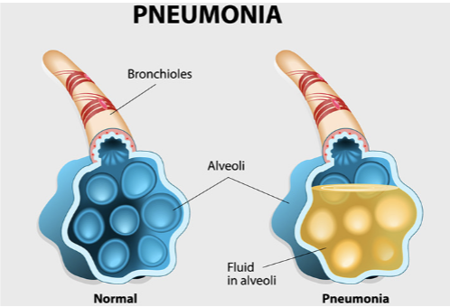 <ul><li><p><strong>CAUSE</strong></p><ul><li><p><span style="color: red;"><strong><span>Effective </span><u><span>thickness</span></u></strong></span> <span style="color: red;"><strong>of respiratory membrane</strong></span> <strong>INCREASES</strong> dramatically if the lungs become <strong>waterlogged and edematous</strong></p></li></ul></li><li><p><strong>EFFECT</strong></p><ul><li><p>Pneumonia</p></li></ul></li></ul><p></p>