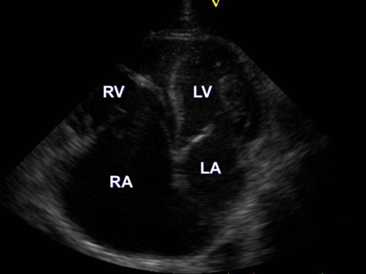 <p>R ventricular dilation due to fibrofatty replacement of the myocardium</p>