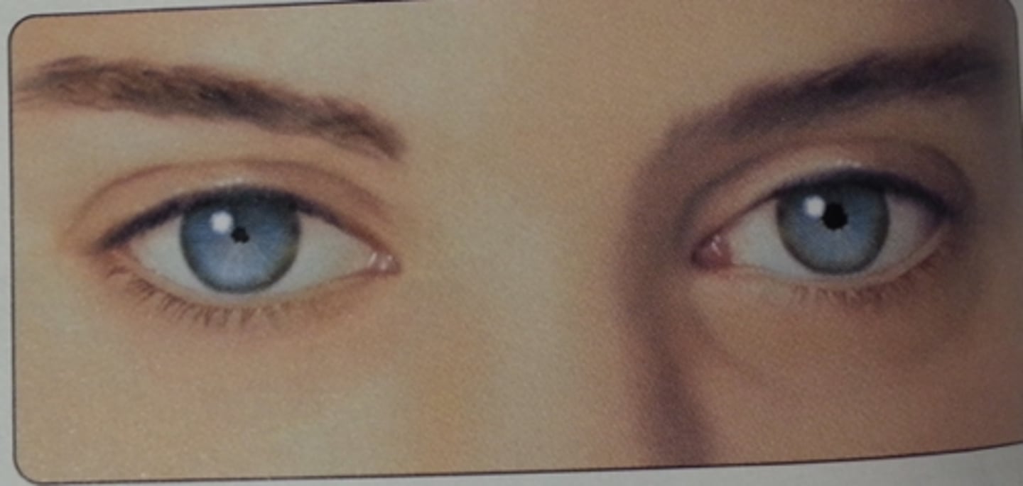 <p><u>Etio:</u> near sight dissociation, Treponema pallidum, <strong>neurosyphilis → </strong>meningitis</p><p><span><u>S&amp;S</u></span>: <strong>bilateral small pupils,</strong> <strong>constrict on accommodation, <mark data-color="#edef00" style="background-color: #edef00; color: inherit">do not constrict when exposed to bright light</mark></strong></p><p><span><u>Testing</u></span>: lumbar puncture</p><p><span><u>Tx</u></span>: report neurosyphilis, <strong>IV abx for 10-14 days</strong></p>