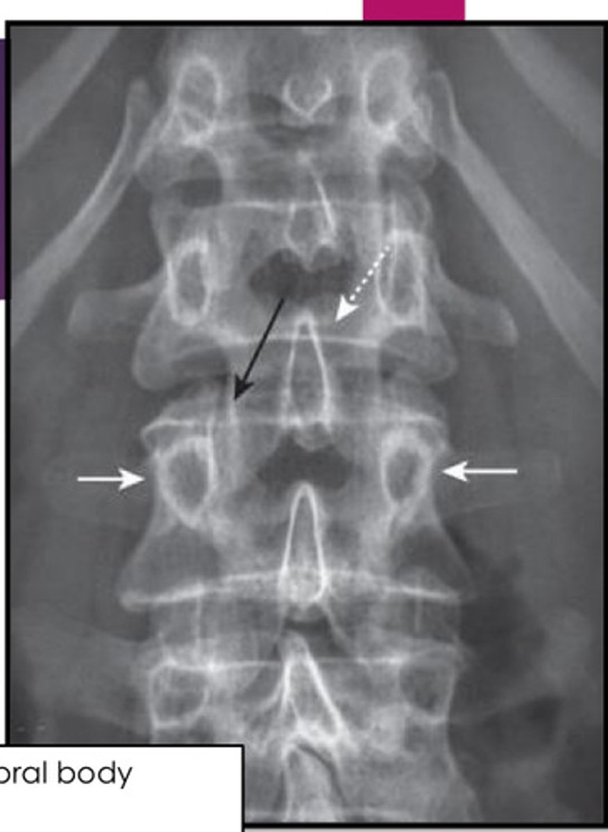 <p>white arrows: 2 pedicles on side of vertebral body</p><p>white dotted arrow: spinous process</p><p>black arrow: facet joint</p>