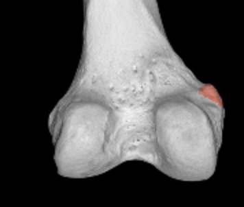 <p>most prominent bump on medial epicondyle of femur </p>