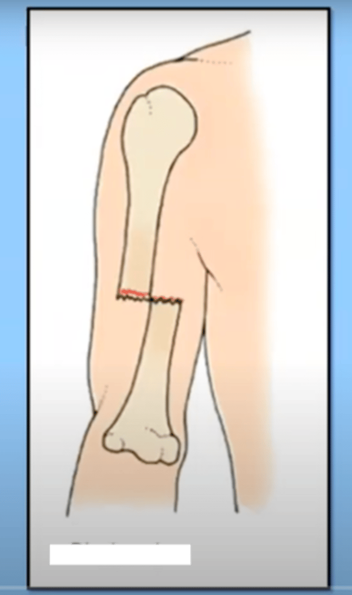 <p>the two main bone fragments are out of alignment</p>