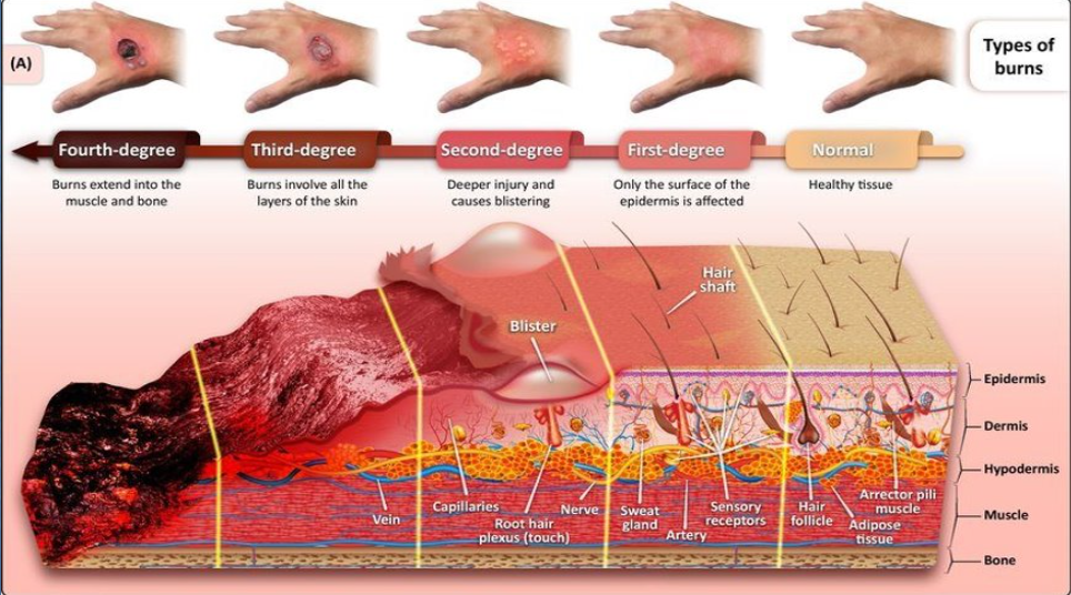 <p>1.Common Symptoms-</p><p>*Redness</p><p>*swelling</p><p>*pain</p><p>*peeling of skin</p><p>*shock</p><p>*white or charrded skin</p><p><mark data-color="purple">First Degree</mark>-(superficial Parcial-thickness)effect outerlayer[epidermis], notice redness very sensitive to touch, skin will appear blanched when light pressure is applied. involve minimal tissue damage Sunburn is a good example of a first-degree burn.</p><p><mark data-color="purple">Second Degree</mark>-(deep partial thickness)affect both the outer layer(epidermis) &amp; underlying layer (dermis)causing redness, pain, swelling and blisters. affect sweat glands, and hair follicles.If not properly treated, swelling and decreased blood flow in the tissue can result in the burn becoming a third-degree burn.</p><p><mark data-color="purple">Third-degree</mark>- (full thickness)affect the epidermis, dermis and hypodermis, causing charring of skin or a translucent white color, with coagulated vessels visible just below the skin surface. Healing from third-degree burns is very slow due the skin tissue and structures being destroyed. Third-degree burns usually result in extensive scarring.</p>