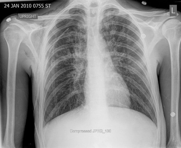 <p>the sharp corner where the <strong>diaphragm meets the ribs</strong> (chest wall) on each side of the lungs. </p>