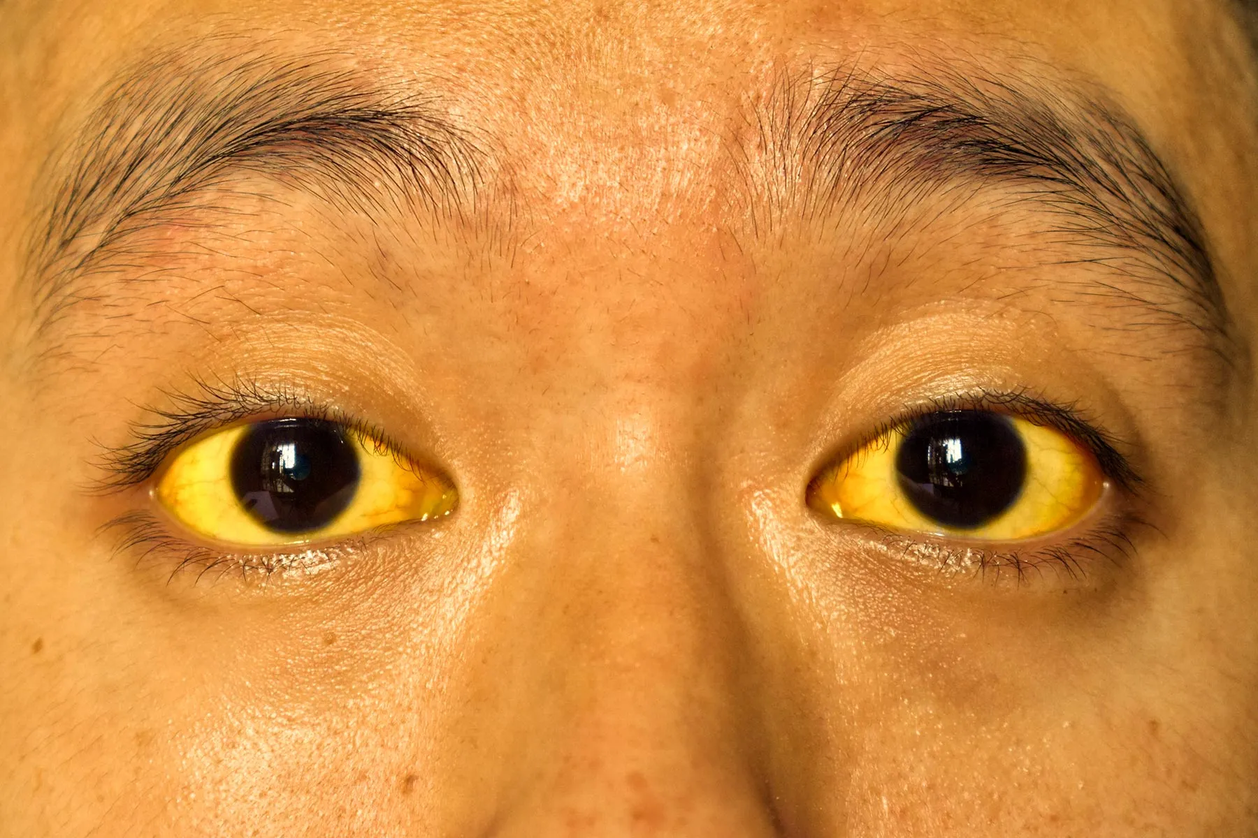 <p><strong>Jaundice</strong>: possible liver or gallbladder disease </p>