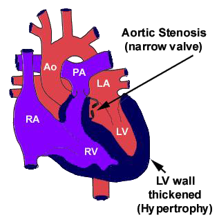 <p>valvular stenosis</p>