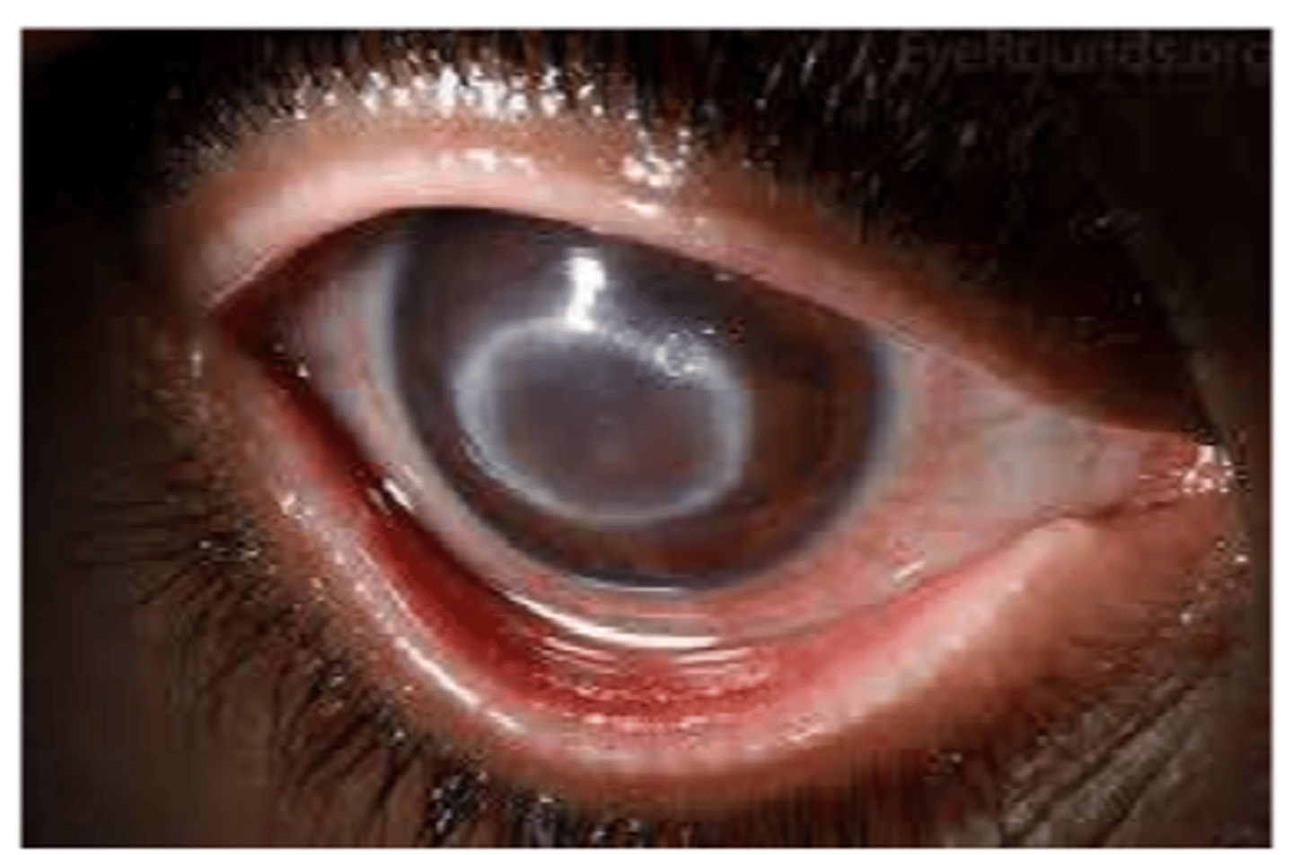 <p>occasional, irregular occurence such as...</p><p>food-borne disease</p><p>Creutzfeld-Jakob disease</p><p>Acanthamoeba keratitis</p>