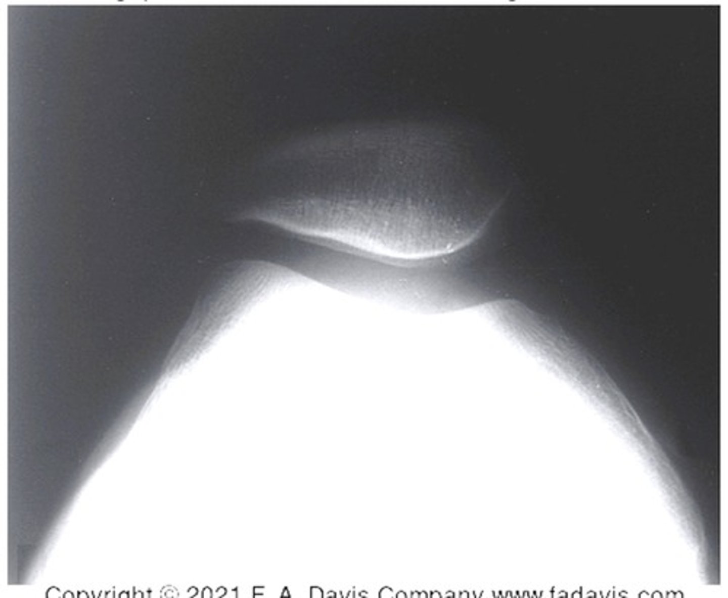 <p>tangential view of the patellofemoral joint</p><p>3 multiple choice options</p>