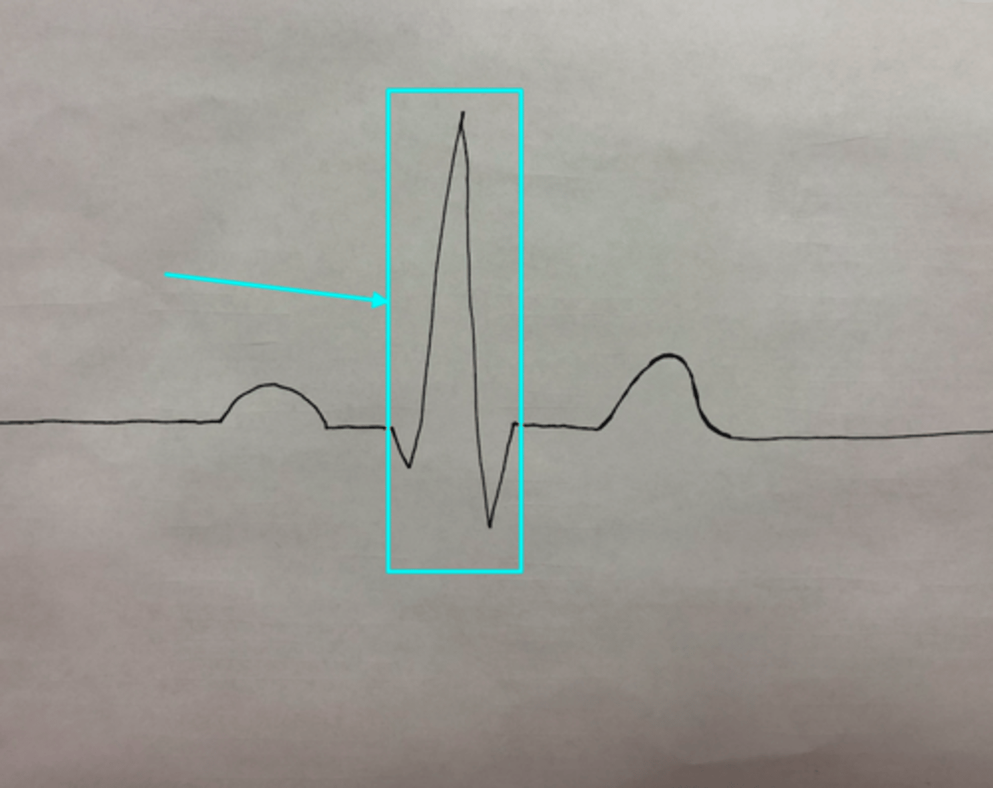 <p>What feature of an ECG is the blue arrow pointing at?</p>