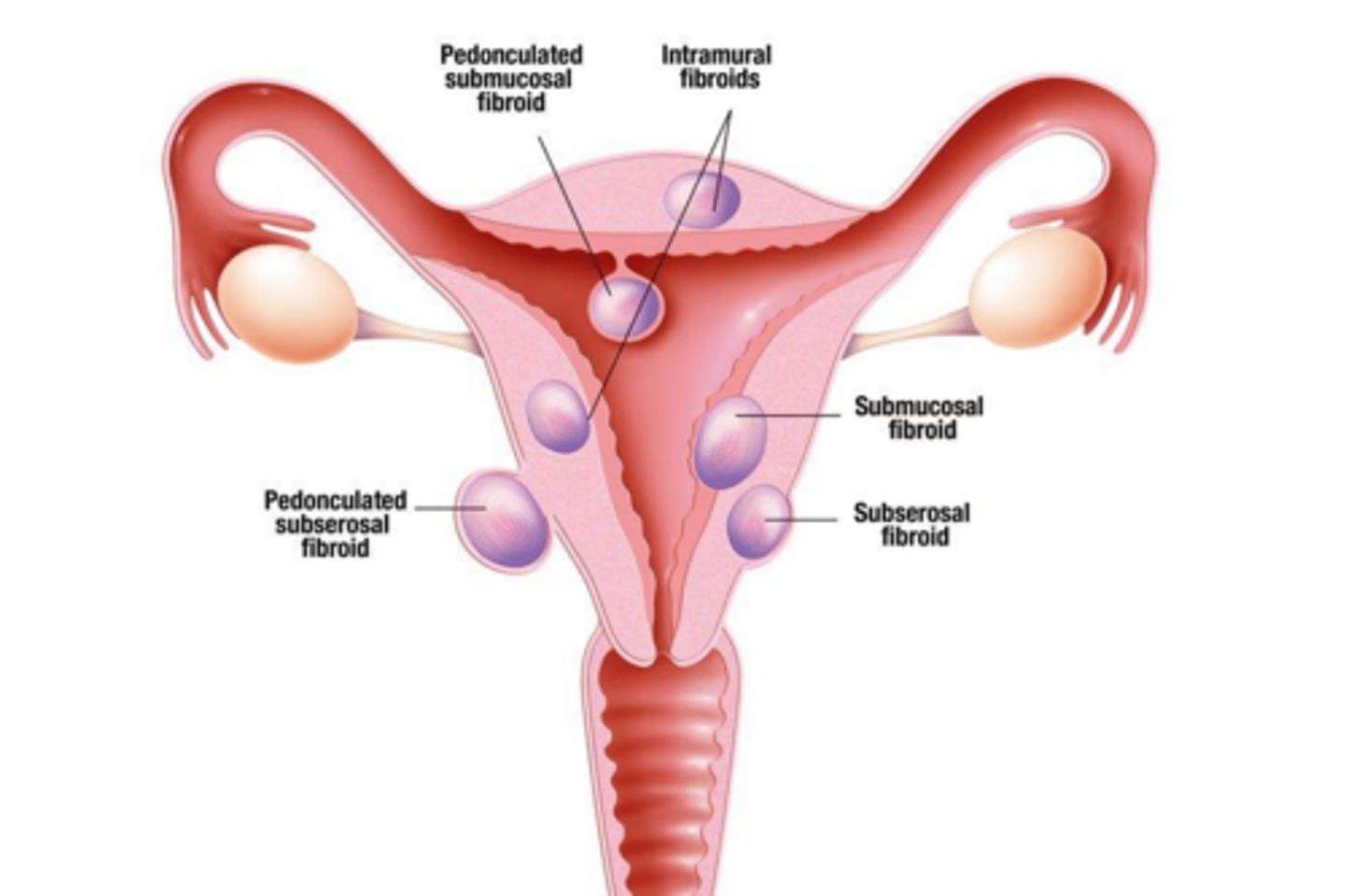 <p>Submucosal fibroids.</p>