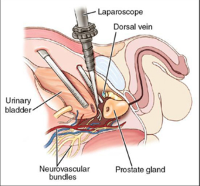 <p>the prostate gland w. capsule, seminal vesicles, vas deferens, and pelvic lymph nodes are excised. Laparoscopic or robotic-assisted.</p><p>Used to treat <strong>prostate cancer</strong></p>