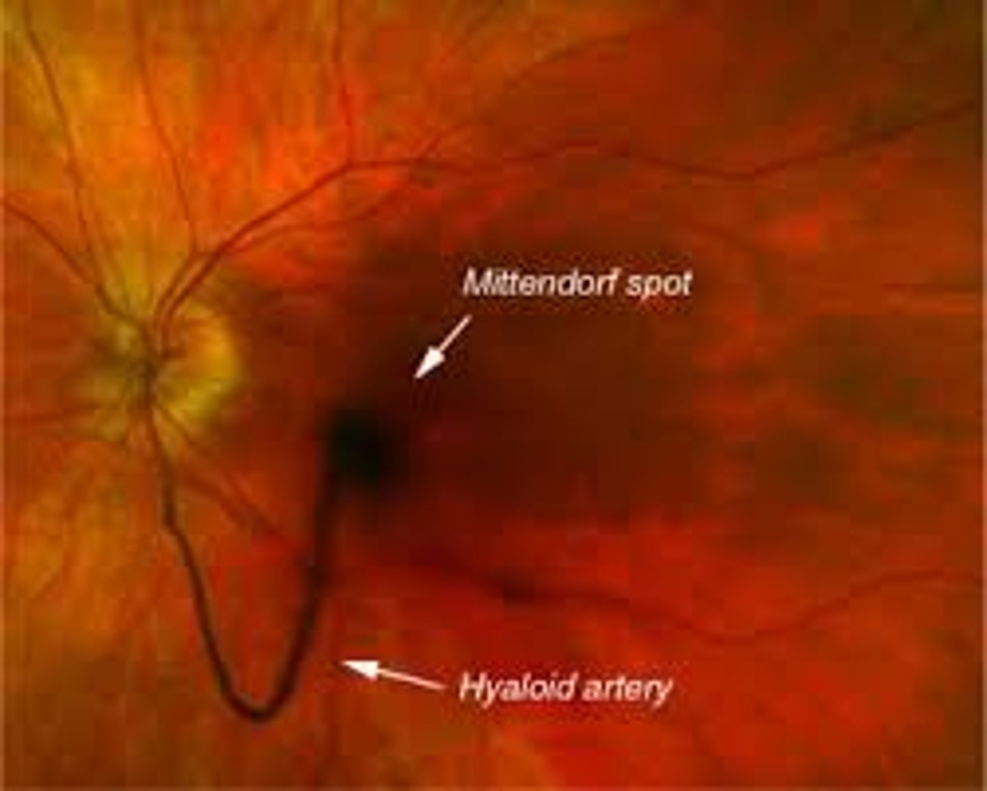 <p>persistent hyaloid</p>