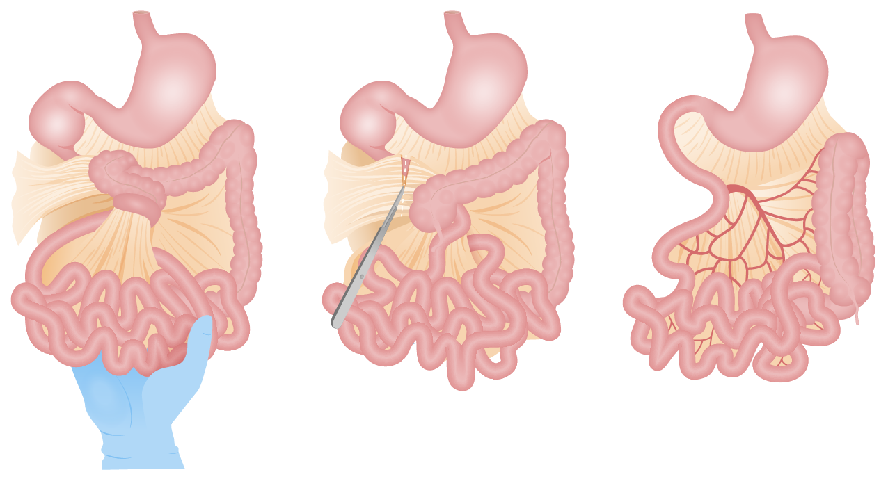 <p>The leftmost image is depicts a volvulus. What disease causes a volvulus? </p><p>a. Malrotation </p><p>b. Intussusception</p><p>c. Appendicitis</p><p>d. Celiac</p>