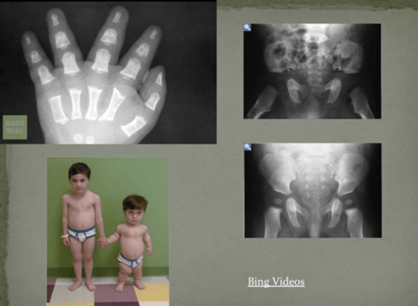 <p>achondroplasia</p>