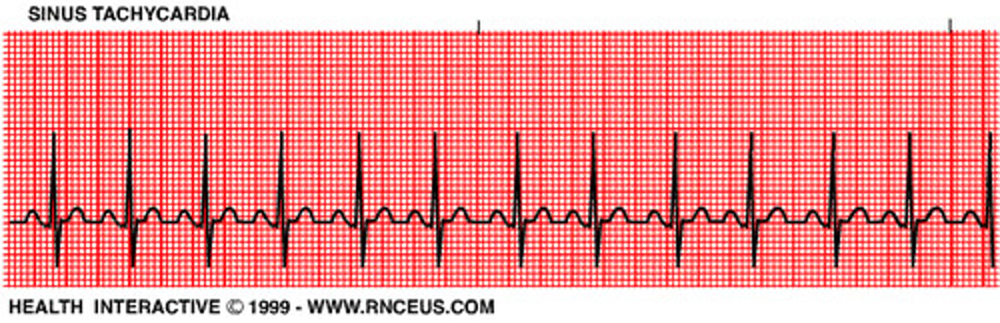 <p>Regular</p><p>Rate: 100-150</p><p>P Wave: Present, upright</p><p>PR Interval: 0.12-0.20 sec</p><p>QRS: <0.12 sec</p>
