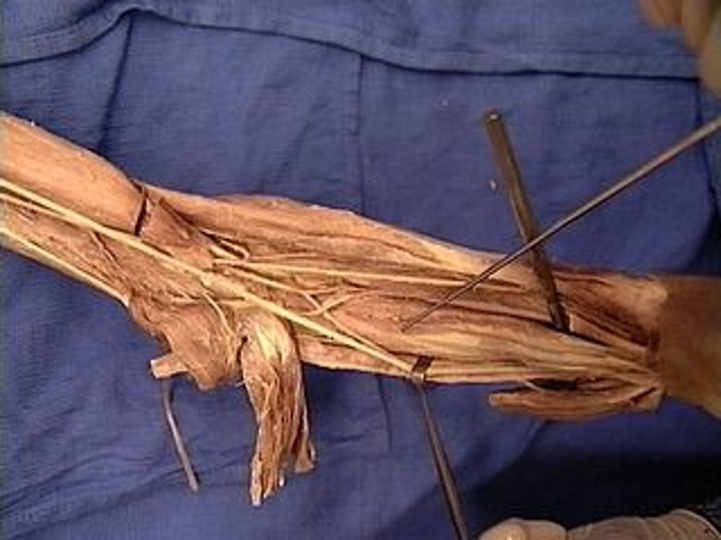 <p>Bases of distal phalanges of digits 2-5, palmar side by four separate tendons</p>