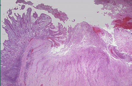 <p>Gastric Ulcer </p>