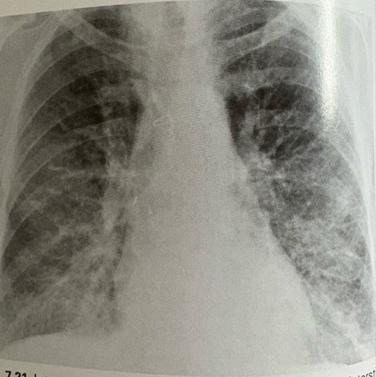 <p>what pathology is present?</p>