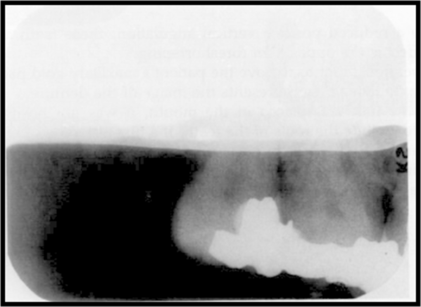 <p>-Film manual processing error</p><p>-Blank image = Developer level too low to cover the entire film - the fixer will remove emulsion from the uncovered area and cause to it to clear the image</p>