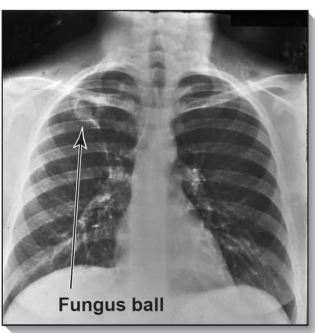 <p>Amphotericin B or voriconazole; itraconazole if intolerant. High-risk patients: filtered air and antifungal prophylaxis (voriconazole or posaconazole).</p><p>Transplant patients at risk, especially stem cell.</p>