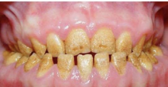 <p>Hierbij is er een onvolledig ontwikkeld glazuur. Er was dus een stoornis in de vorming.</p>