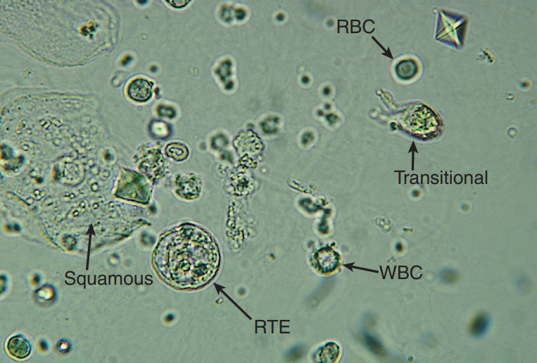 <p>Epithelial cells that vary in size and shape depending on are of origin and is indicative of necrosis of renal tubules</p><ul><li><p>PCT: “columnar/convoluted cells”; larger, rectangular, resemble casts</p></li><li><p>DCT: smaller, round, resemble WBCS and spherical transitional cells</p></li></ul><p></p>