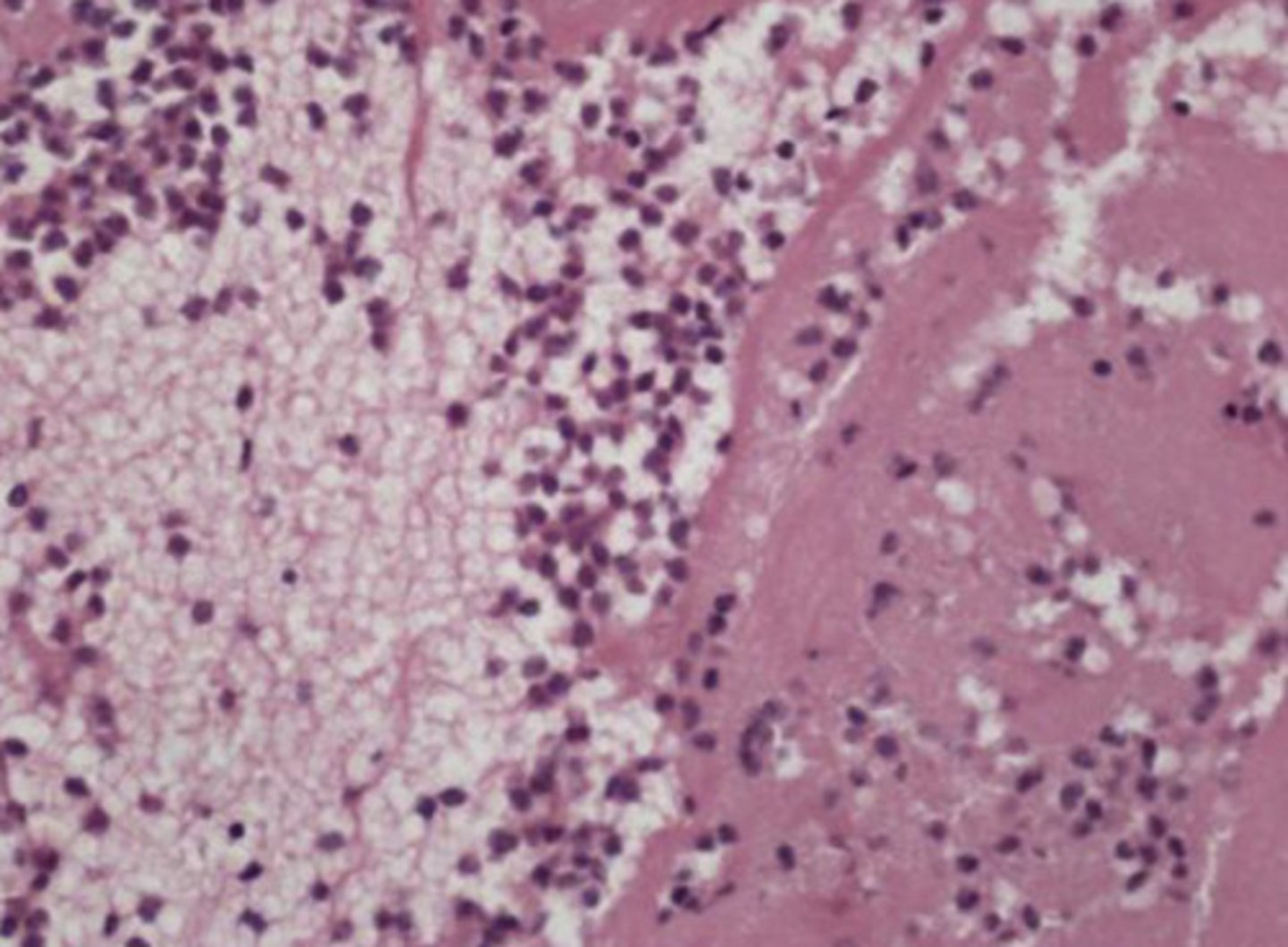 <p>What type of WBC comprise the bulk of the inflammatory cells seen here?</p>