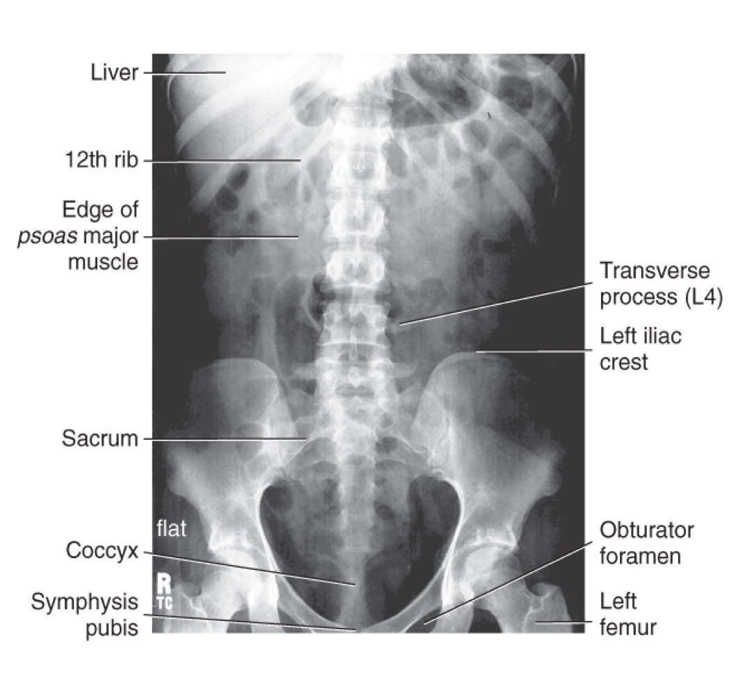 <p>Inferior costal margin</p>