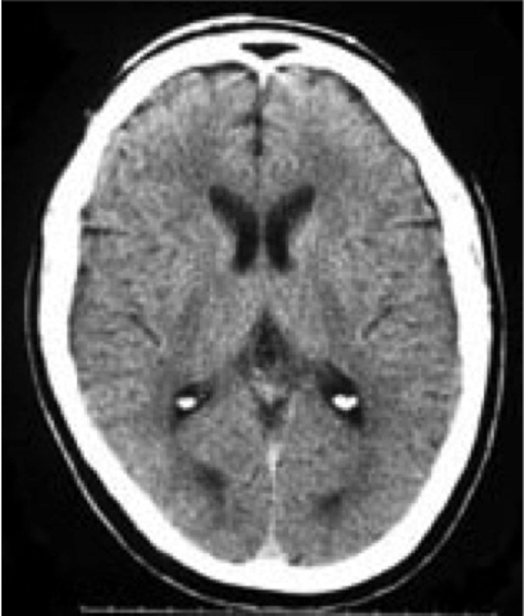 <p>a method of creating static images of the brain through computerized axial tomography</p>