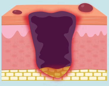 <p>the fatty tissue is injured below the skin (dark purple, &amp; sometimes open wound) </p>
