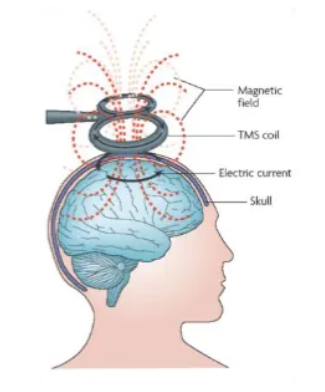 <ul><li><p>TMS is based on the laws of electromagnetic induction. </p></li><li><p>It sends quick pulses of electricity through the coil. </p></li><li><p>Current passing through a coil of wire generates a magnetic field perpendicular to the current direction in the coil. </p></li><li><p>Rapid change of this magnetic field elicits in turn a transient electric field. </p></li><li><p>This electric field affects the membrane potential of nearby neurons, which may lead to depolarisation and neurons discharging. </p></li></ul><p></p>