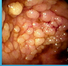 <p><strong>Colon Polyps: Types </strong></p><p>-Mass or finger like projection arising from the colonic ______</p><p>-Inflammatory Pseudopolyps → seen in ___, can be associated with surrounding __________ in those with IBD </p><p>-Harmartomatous Polyps → made of normal tissue but growing in disorganized mass. May increase CRC risk in some cases </p><p>-Serrated Polyps → sawtooth appearance, larger in size. _____ (hyperplastic) to increased risk of CRC (sessile serrated and serrated adenoma) </p><p>-_____________ polyps → most common __________ polyp in the colon</p><ul><li><p>Tubular (MC), villous (high risk for cancer), tubulovillous</p></li><li><p>All have some form of dysplasia </p></li></ul><p></p>