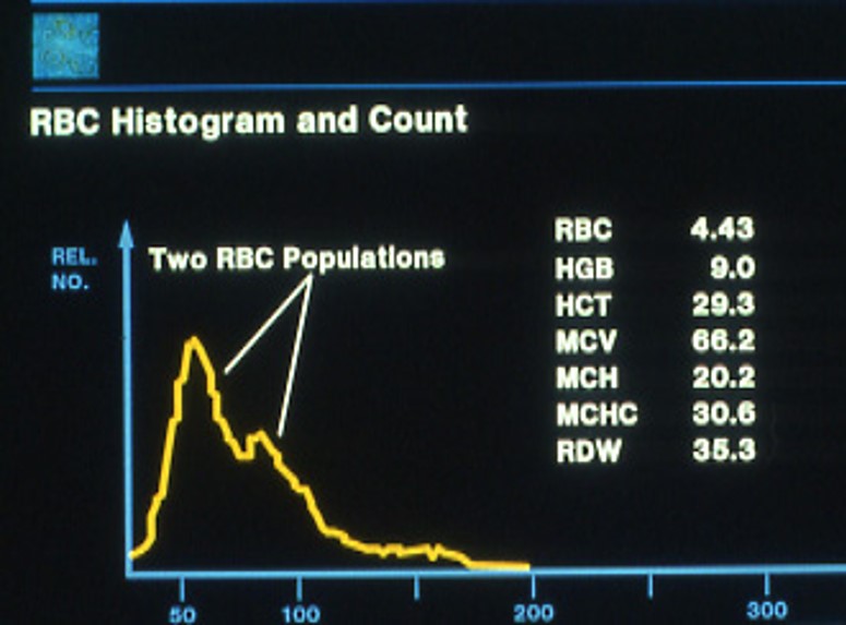 Two peaks

MCV of both

RDW