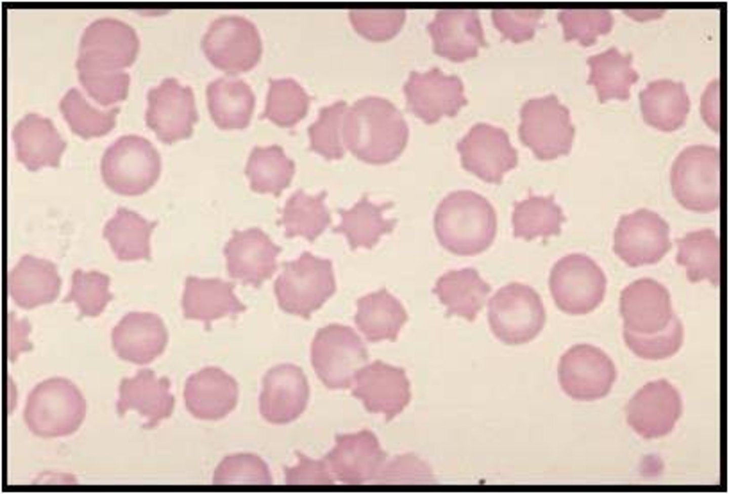 <p>- Spherical RBCs with uneven spiny projections </p><p>- Increased cholesterol</p><p>- Decreased lecithin</p><p>- Etiologies: Abetalipoproteinemia (3-4+), Liver disease (2-3+), Retinitis pigmentosa (1-2+)</p>