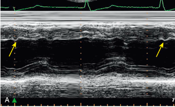 <p>What is the arrow pointing to?</p><p>What condition is this finding demonstrated in?</p>