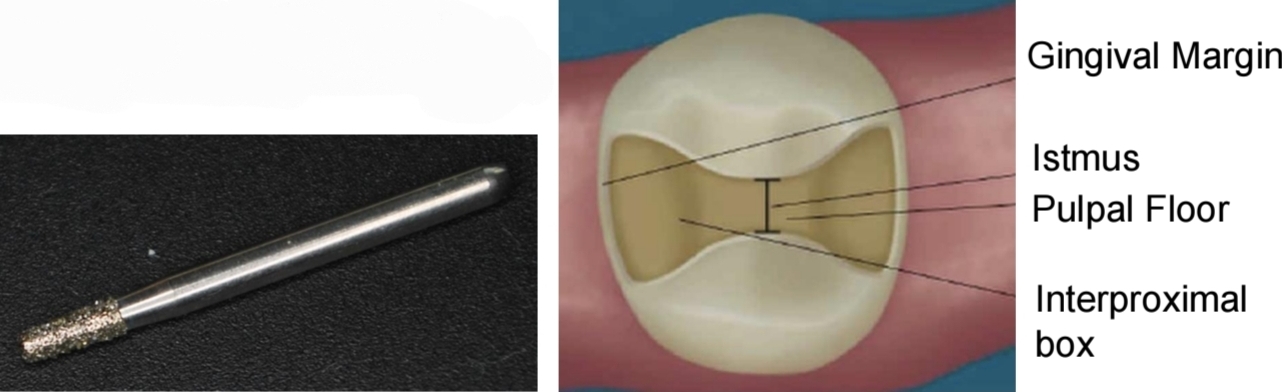 <p>Class 1 or 2 cavity preparation</p><p class="has-focus">Diamond bur, taperd flat head and rounded tips</p><p class="has-focus"><strong>Divergent</strong> walls 10-15°</p><p class="has-focus">Isthmus max width 1.5-2mm</p><p class="has-focus">Occlusal plane 1.5mm depth and perpendicular to path of insertion</p><p class="has-focus">Proximal boxes more that 1mm axial depth, and 2mm b/l</p><p class="has-focus">Remove contact points</p><p class="has-focus">No bevel</p><p class="has-focus"></p>