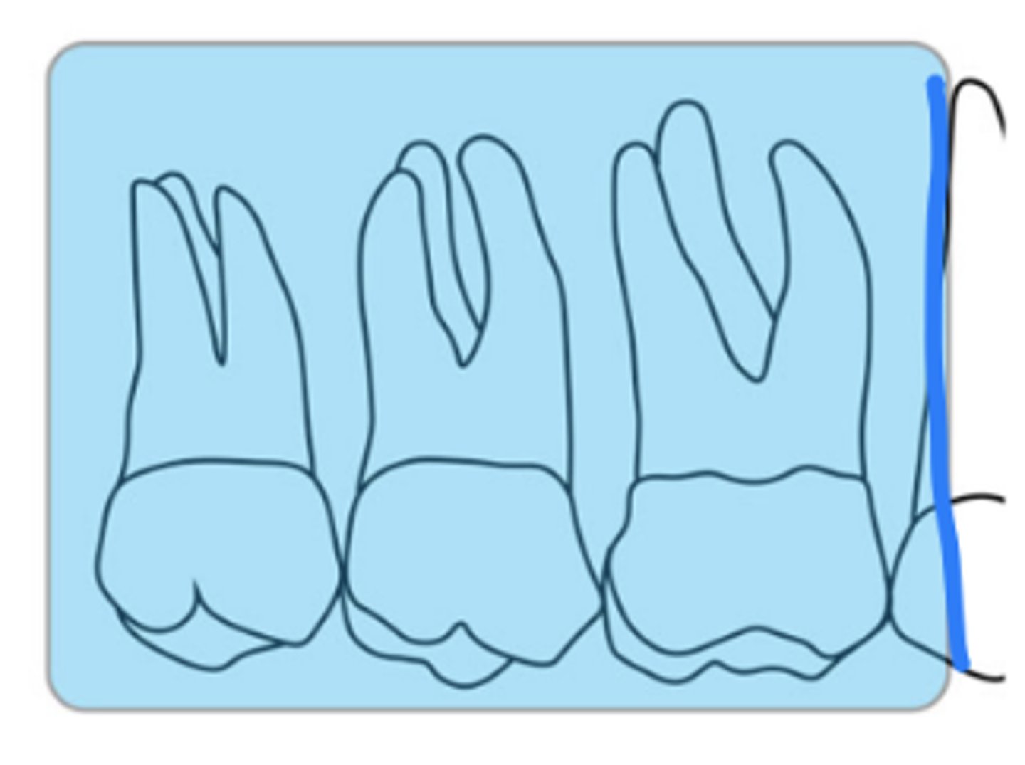 <p>size 2 </p><p>at least 4 mm distal of the 2nd molar</p><p>first molar is captured with premolars</p>