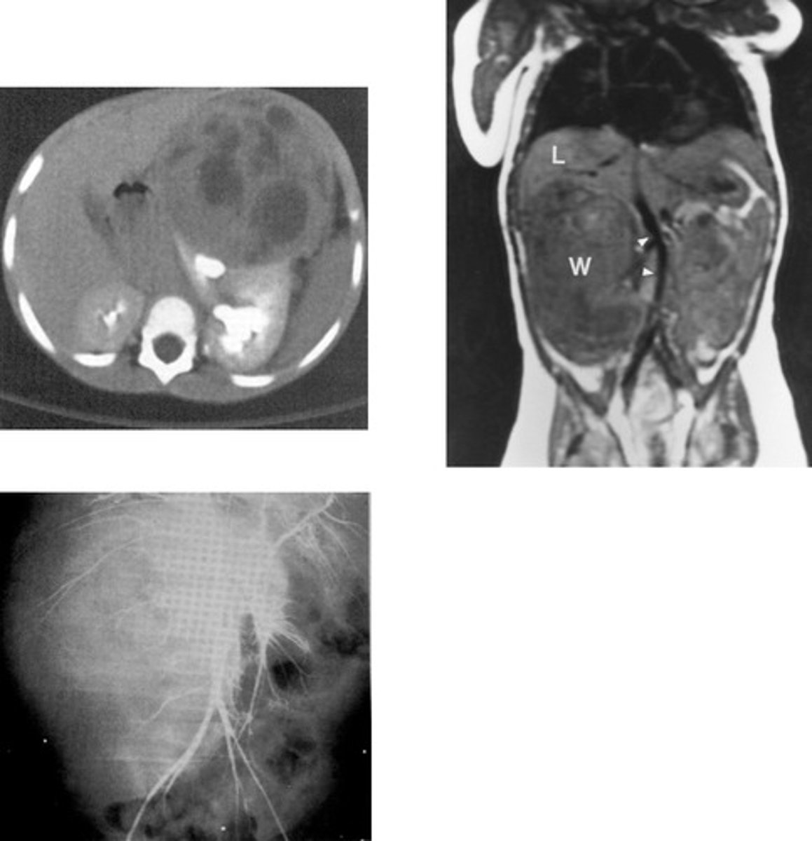 <p>- What type of renal neoplasm arises from the embryonic renal tissue that distorts the calyces and creates a vine like blood supply?</p><p>- This is the most common abdominal neoplasm in who?</p>
