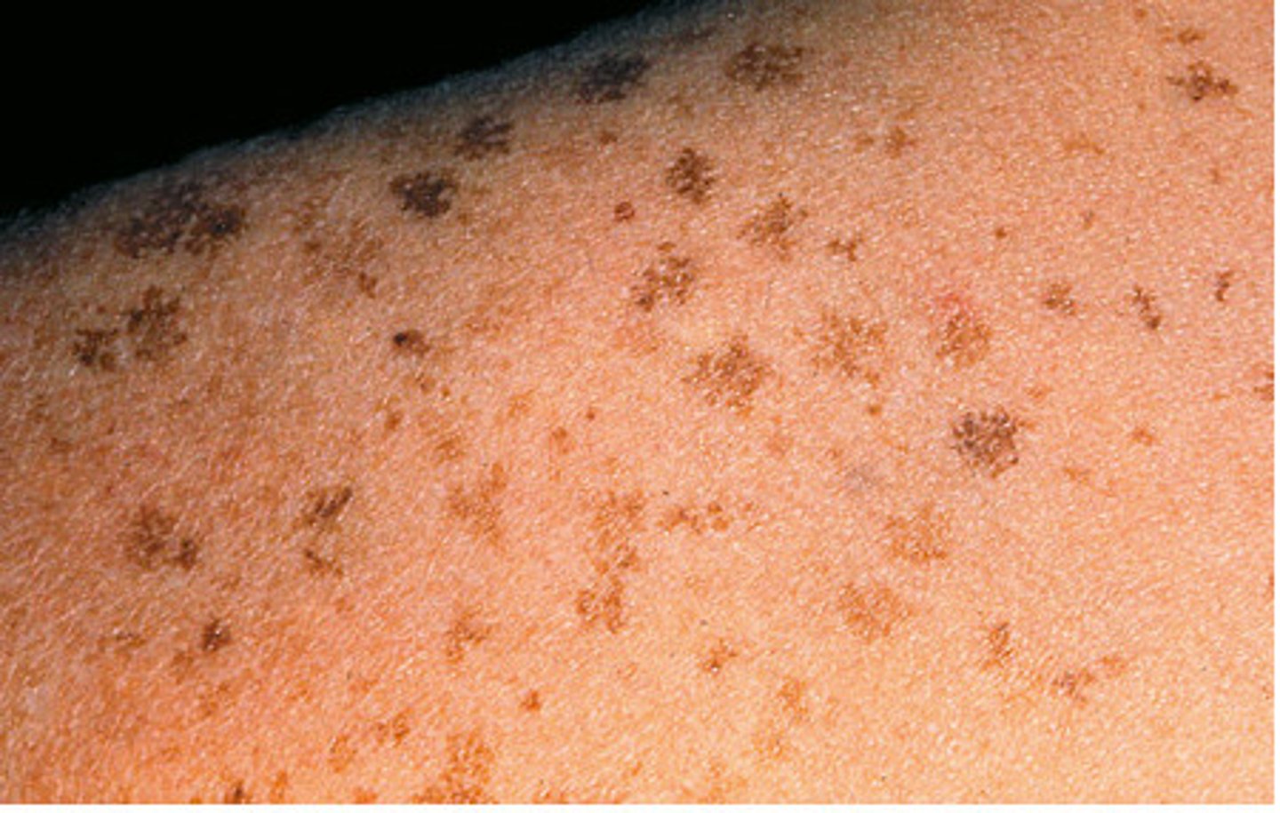 HSN pictures Flashcards Knowt