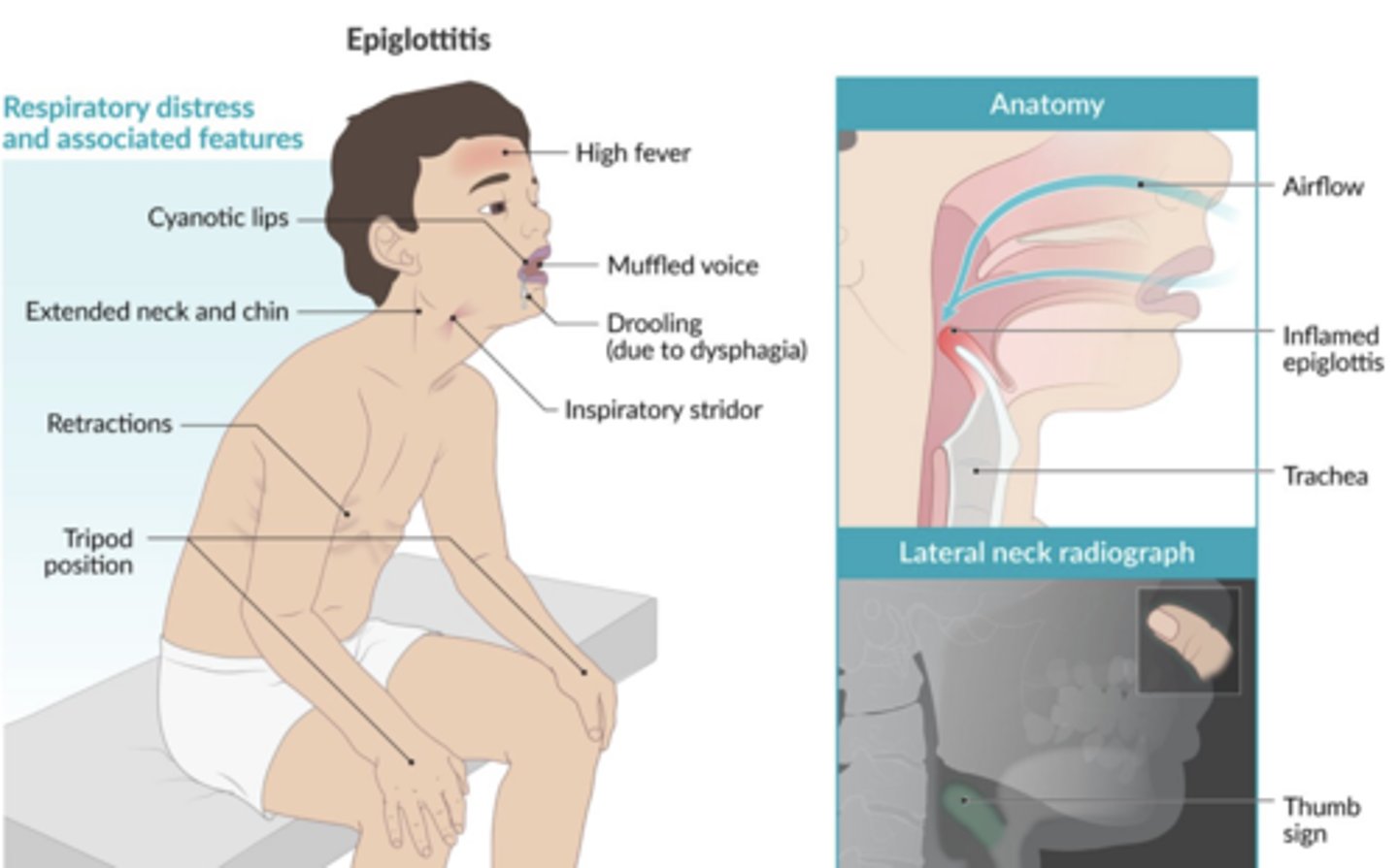 <p>Dysphagia, drooling, respiratory distress</p><p>Tripod position</p><p>Stridor</p>