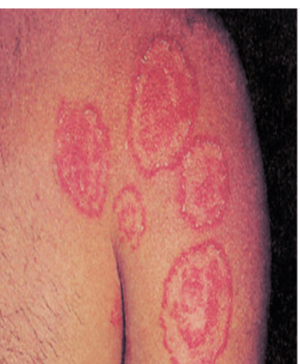 <p>-Ringworm (fungal infection)</p><p>Treatment:</p><p>-Antifungal cream/powder</p>
