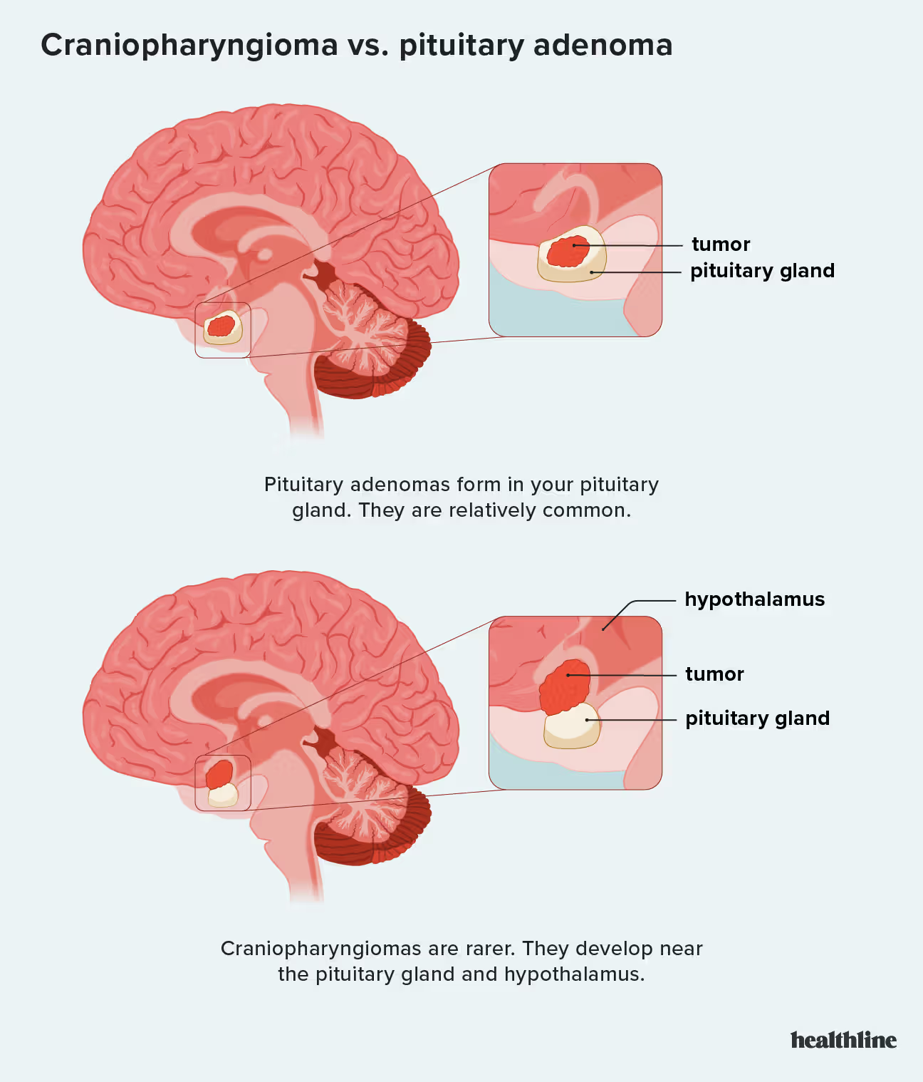 <ul><li><p>tumors of the anterior pituitary gland</p></li><li><p>mostly slow-growing and benign</p></li><li><p>symptoms related to over or underproduction of hormones produced by the pituitary gland</p></li><li><p>Prolatinoma causes vision problems from putting pressure on nerves and optical structures or infertility from unbalanced hormones</p></li><li><p>Somatotroph cell adenoma causes growth in the hands and feet because of soft tissue swelling from overproduction of growth hormones </p></li></ul>