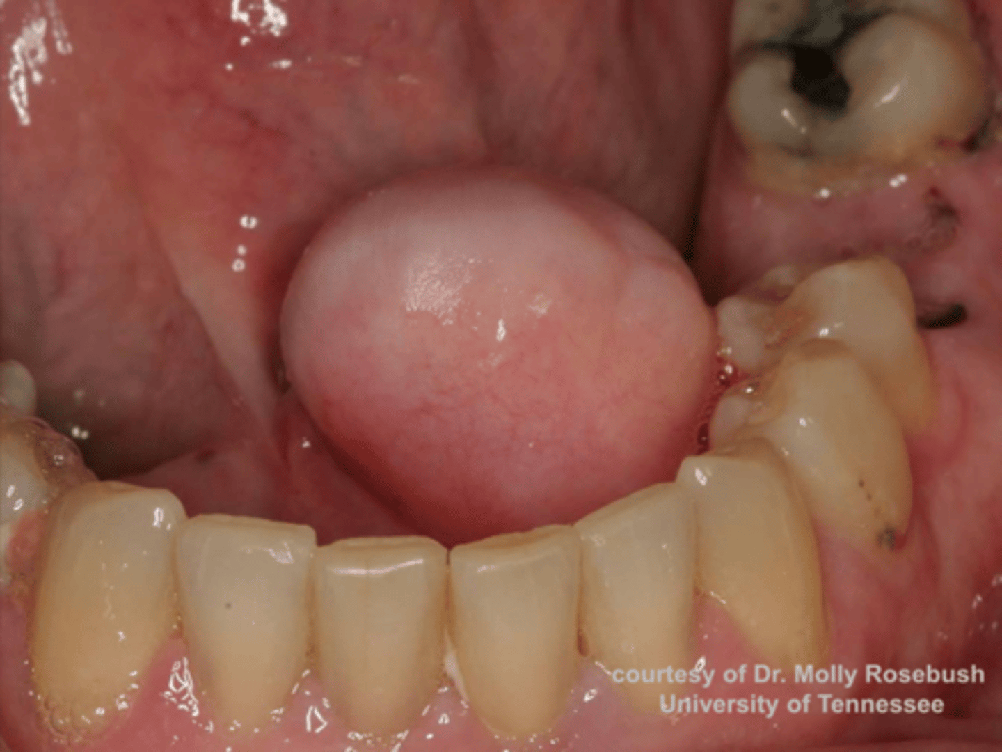 <p>patient presents with nodule on the floor of the mouth that is and slight yellowish tint. Histopathology showed Well-circumscribed mature adipose tissue. What do you suspect?</p>