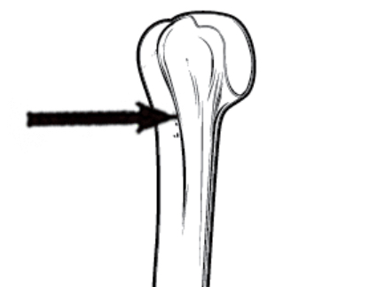 <p>Deep, narrow groove</p>