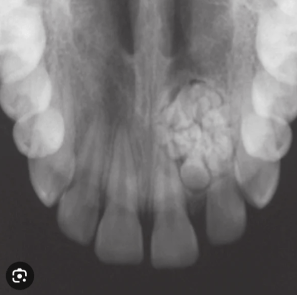 <p>found in anterior maxilla</p><p>contains tiny tooth-like structures</p><p>xray- well defined, radiopaque, tooth resembling</p>