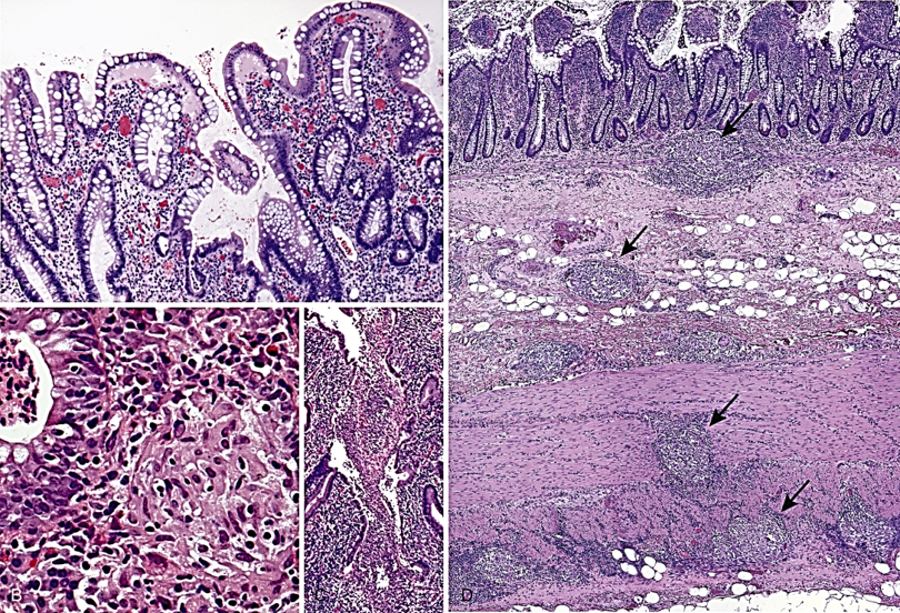 <p>Targets the GI tract; antigens are Tubulin beta-5 and desmin</p>