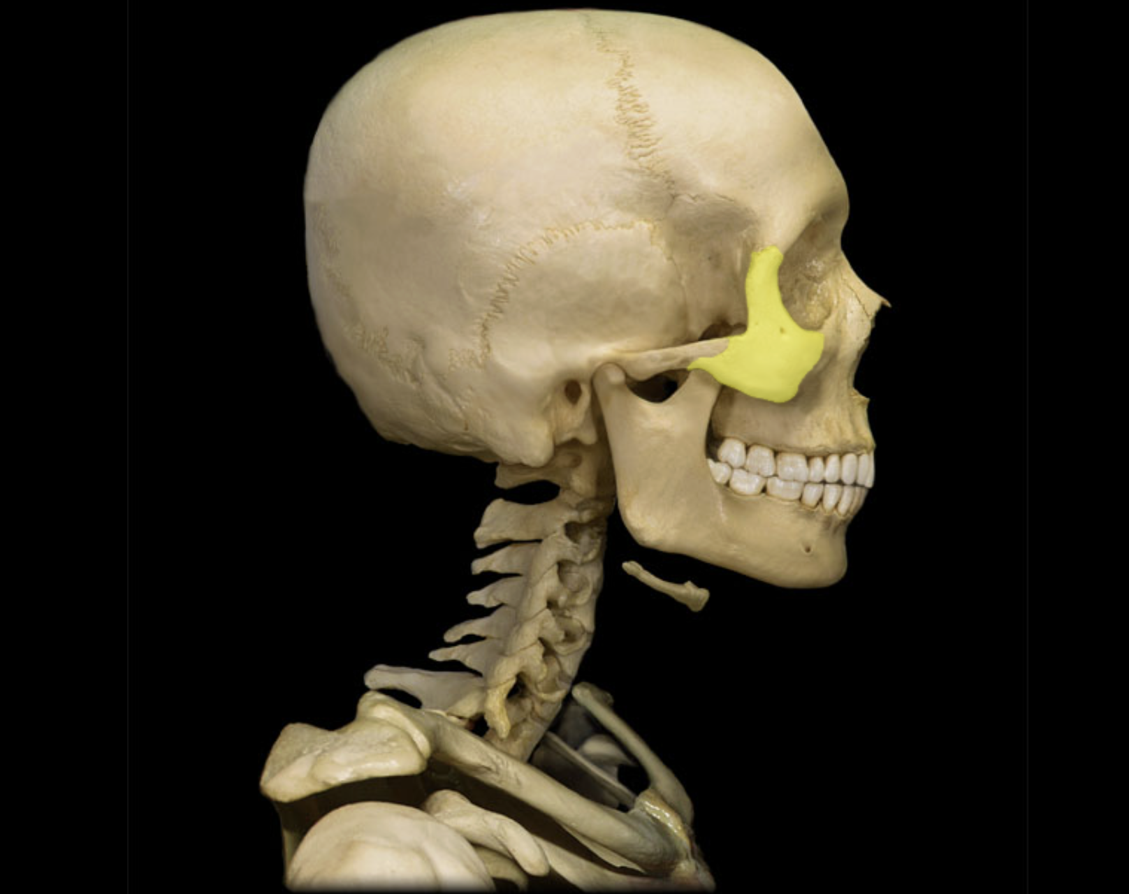 <p>Zygomatic bone</p>