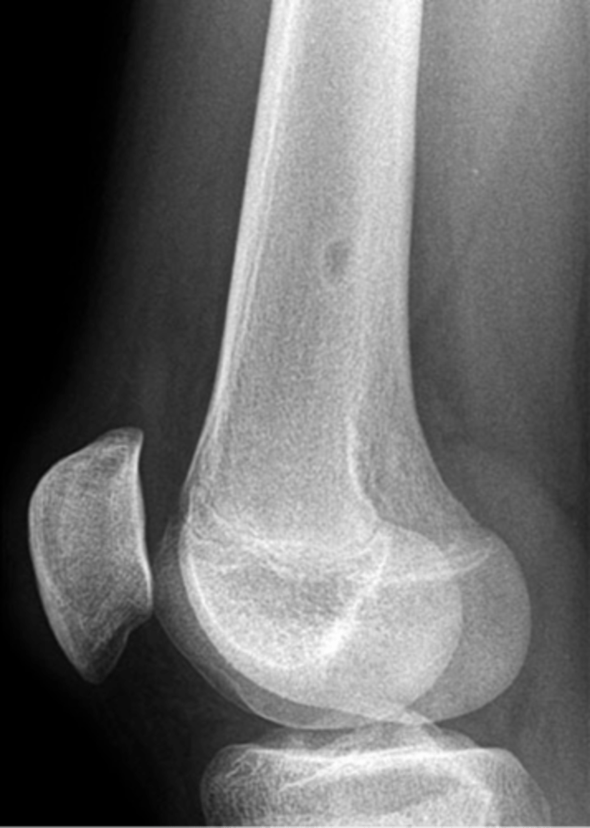 <p>Larger non-ossifying fibroma lesions &gt;_____ may fracture</p>