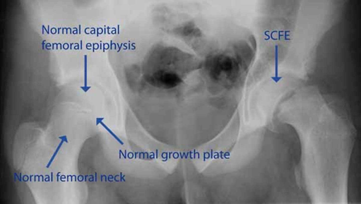 <p>- Plain film showing posterior displacement of the femoral head, like an ice-cream scoop slipping off a cone.</p>