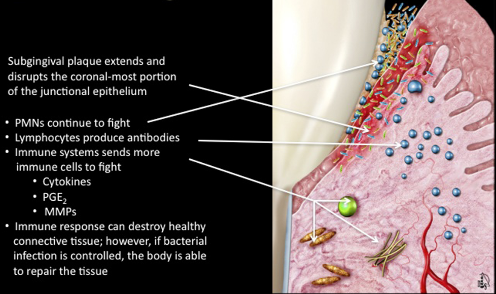 <ul><li><p>subgingival plaque extends and disrupts the coronal-most portion of the junctional epithelium</p></li><li><p>immune response can destroy healthy connective tissue; however, if the bacterial infection is controlled, the body is able to repair the tissue</p><ul><li><p>the destroyed connective tissue also act as an additional food source for the bacteria </p></li></ul></li></ul><p></p>